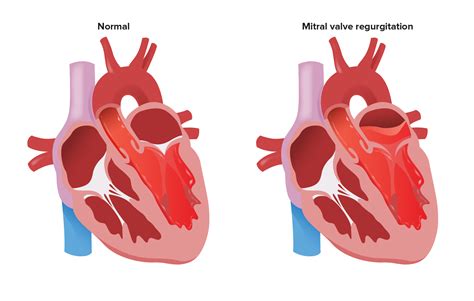 Mental Health and Well-being in Mitral Regurgitation